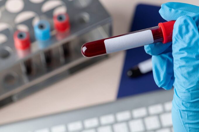 Desarrollan prueba de sangre para detectar cáncer de páncreas en minutos